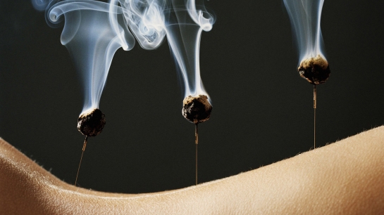 Acupuncture Moxibustion